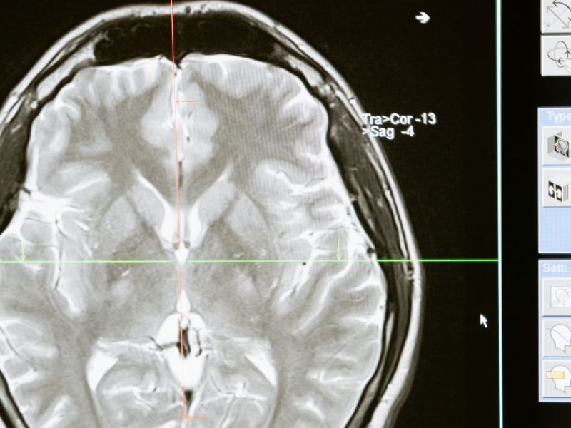 Neurology & Neuro Hospitals in Chennai under CMCHIS– Free Brain & Spine&nbsp;Treatment