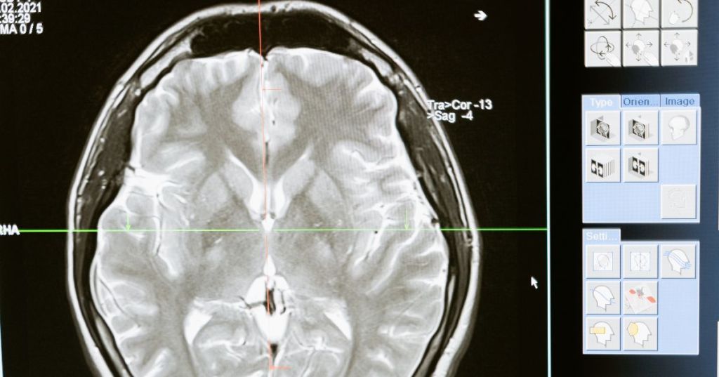 CMCHIS-approved neurology and neuro hospitals in Chennai for free brain, spine, and stroke treatment