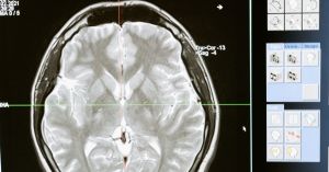 CMCHIS-approved neurology and neuro hospitals in Chennai for free brain, spine, and stroke treatment